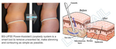Bijgestane de Macht van de het Vermageringsdieetmachine van de Liposuctioncavitatie